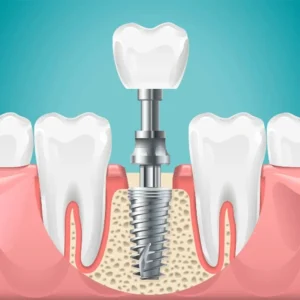 Why Early Tooth Replacement Using Implants Would Stop Jaw Decline