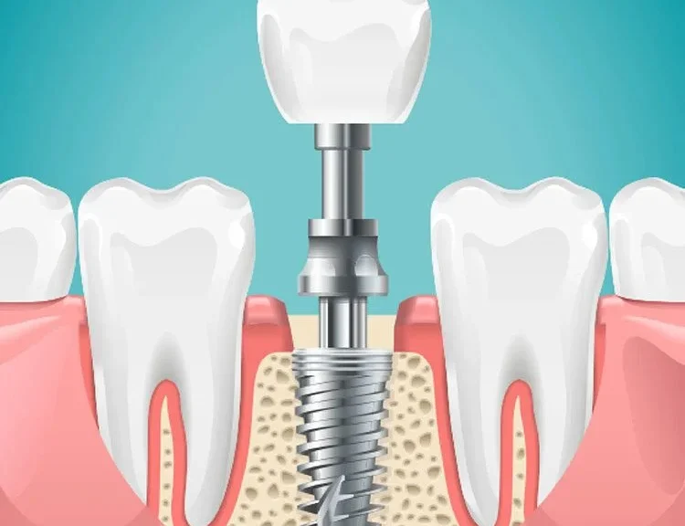 Why Early Tooth Replacement Using Implants Would Stop Jaw Decline