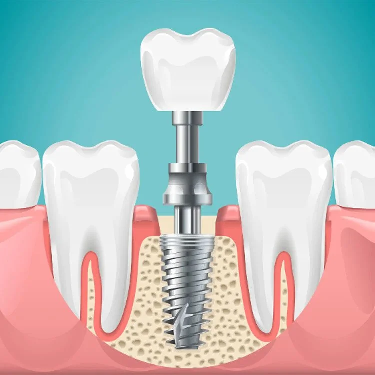 Why Early Tooth Replacement Using Implants Would Stop Jaw Decline